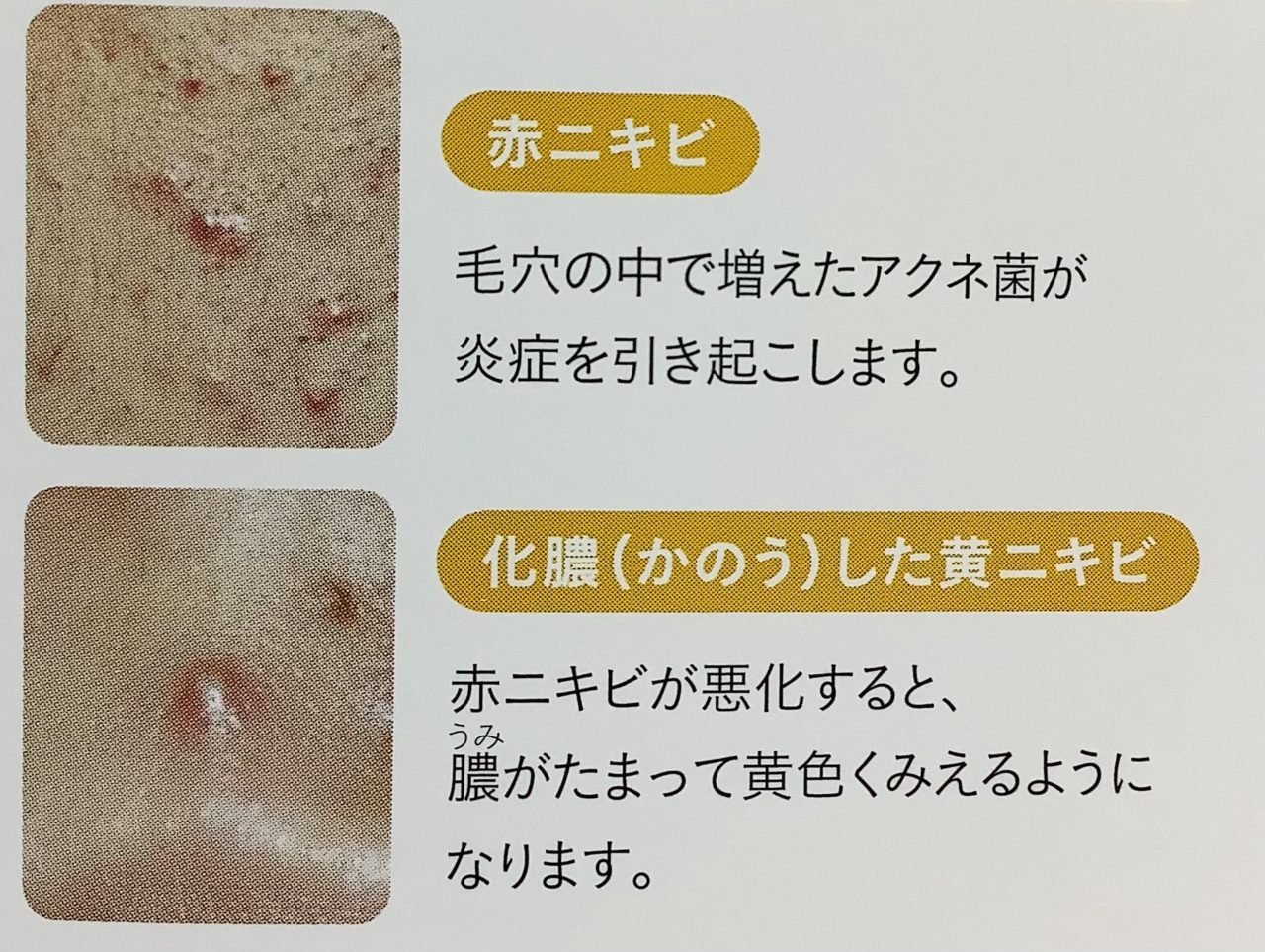 ニキビについて | 名古屋市の皮膚科・美容皮膚科「医療法人寿会 八幡クリニック」